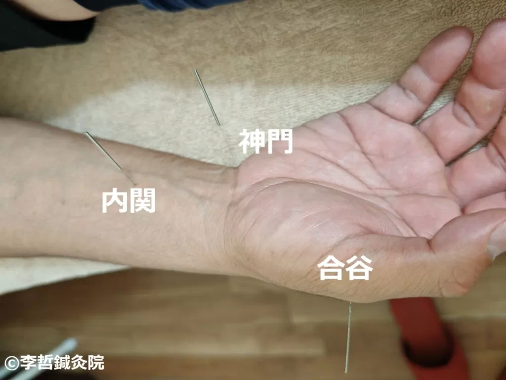 鍼治療中の神門・内関・合谷穴に刺した鍼。白文字でツボ名を明記した手と腕のクローズアップ