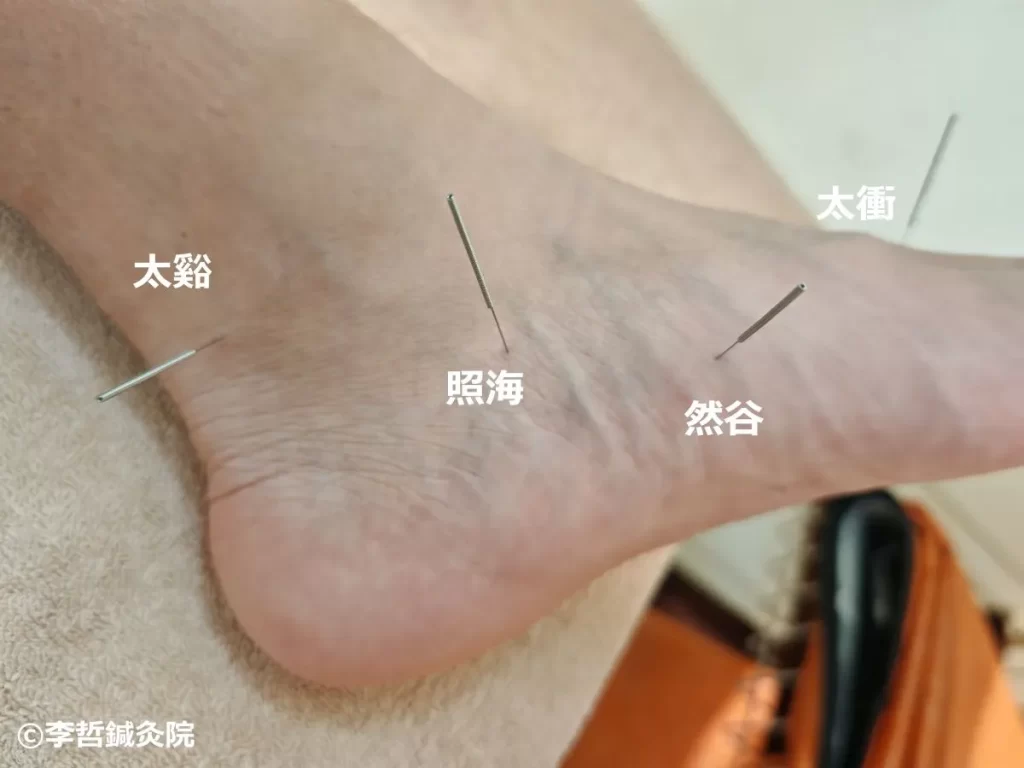 鍼治療中の太谿・然谷・照海・太衝穴に刺した鍼。白文字でツボ名を明記した足のクローズアップ