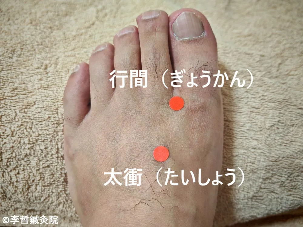片頭痛治療に使う左足の行間・太衝穴　赤シールで位置表示