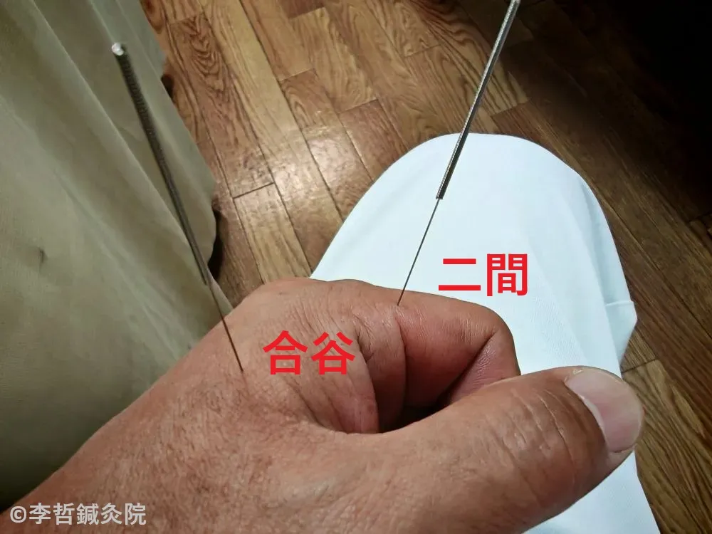 合谷と二間に刺した鍼の写真。ものもらいの腫れを改善するための鍼治療の様子。