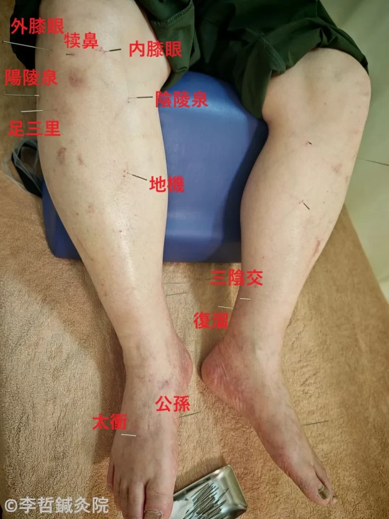 80歳男性の膝痛治療中の鍼刺入写真（内膝眼・外膝眼・鶴頂など主要ツボに赤文字表記）