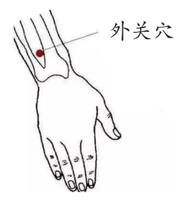 鍼治療で使用した外関穴の位置図。右腕のツボ位置を赤丸で示し、ゴルフ肘の痛みに効果的だったツボ