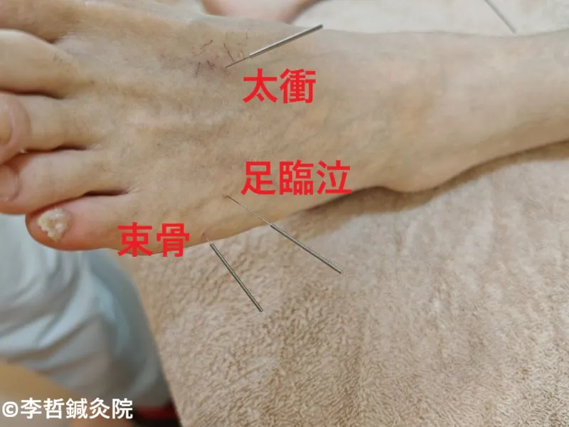 後頭部神経痛の鍼治療で、足の足臨泣・束骨・太衝に刺した鍼。ツボ名を赤文字で表示