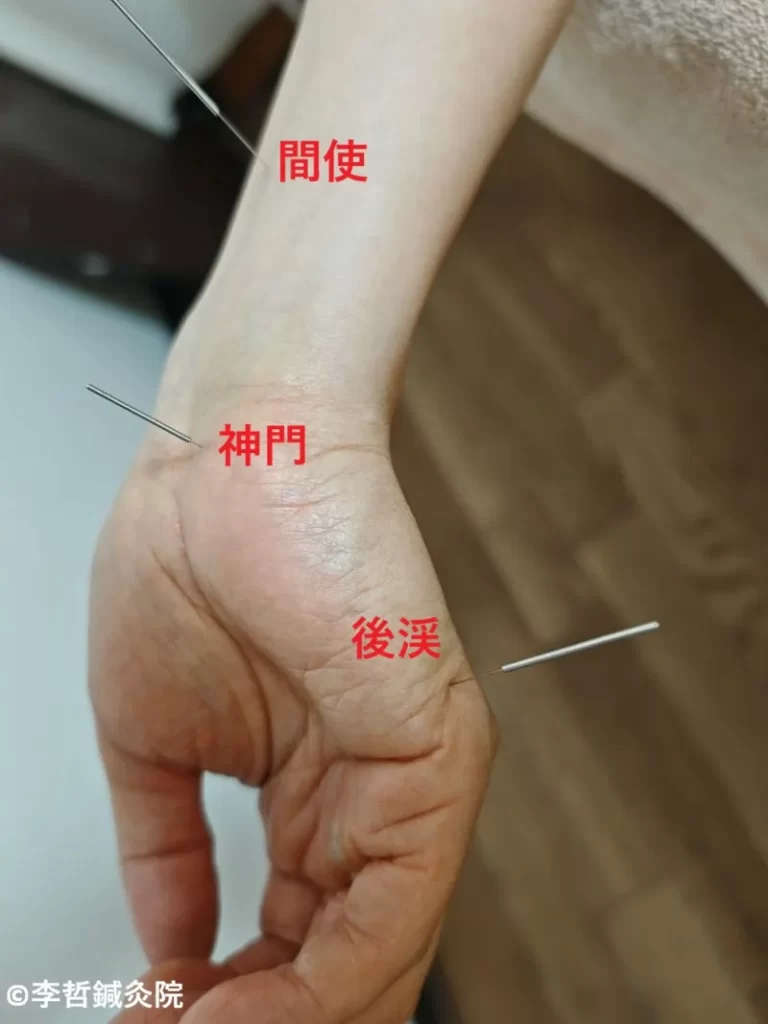 後頭部神経痛の鍼治療で、手の神門・間使・後渓に刺した鍼。ツボ名を赤文字で表示