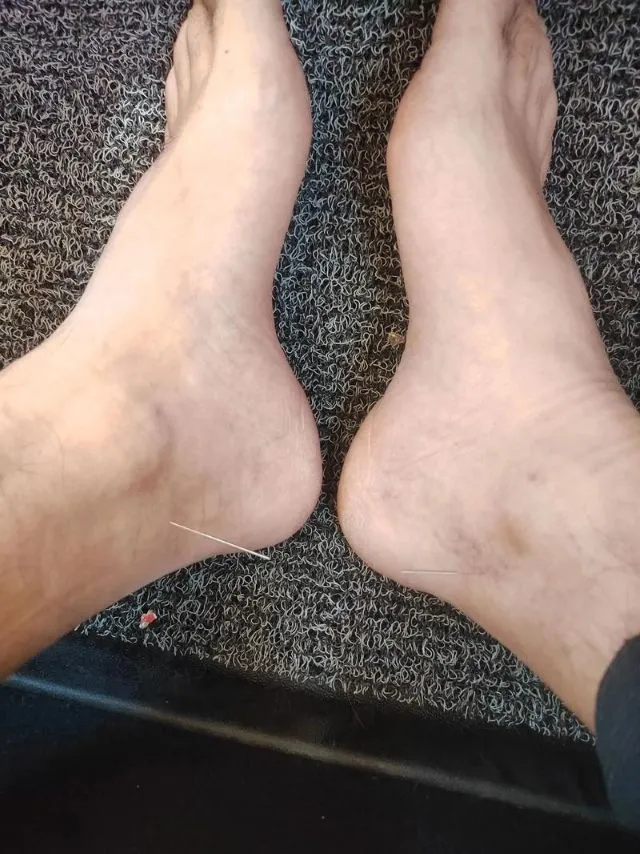 両足の太谿穴に鍼を刺した治療風景 腎経のツボ