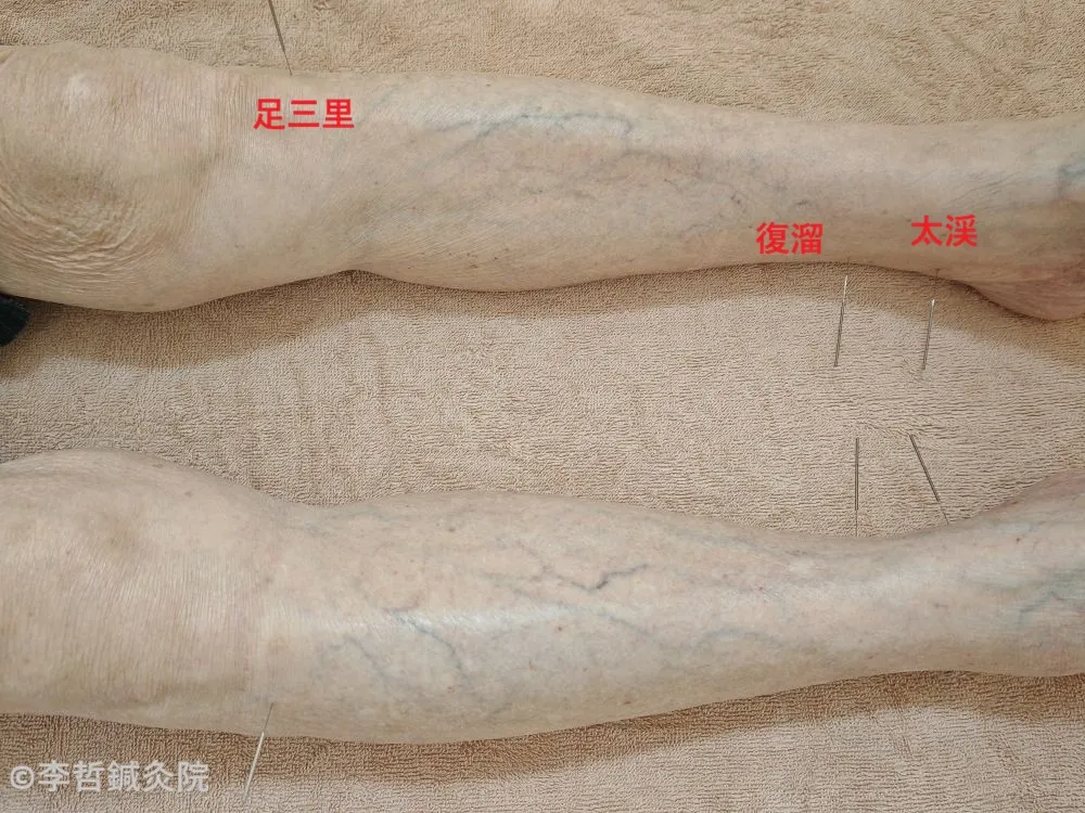 足三里・太渓・復溜に鍼を刺した施術写真。足のツボが赤文字で示されている。