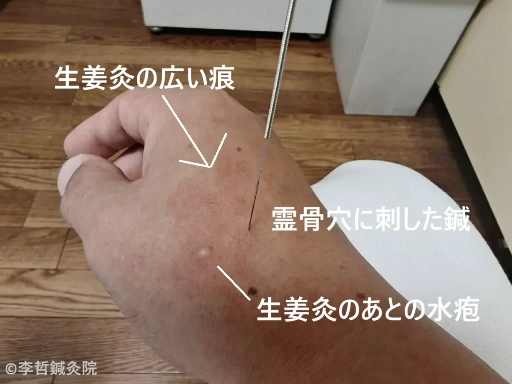 霊骨穴に刺した鍼と、周囲に広がる生姜灸の痕および水疱
