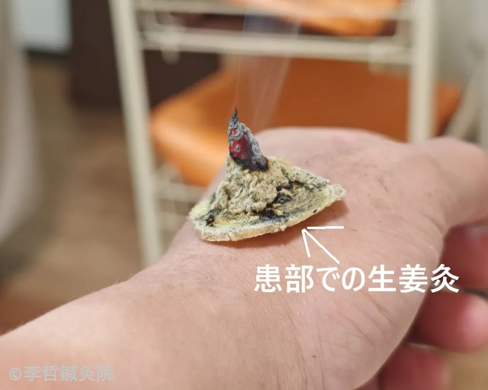 左親指の付け根の患部に置いた赤く燃える生姜灸と立ち上る煙