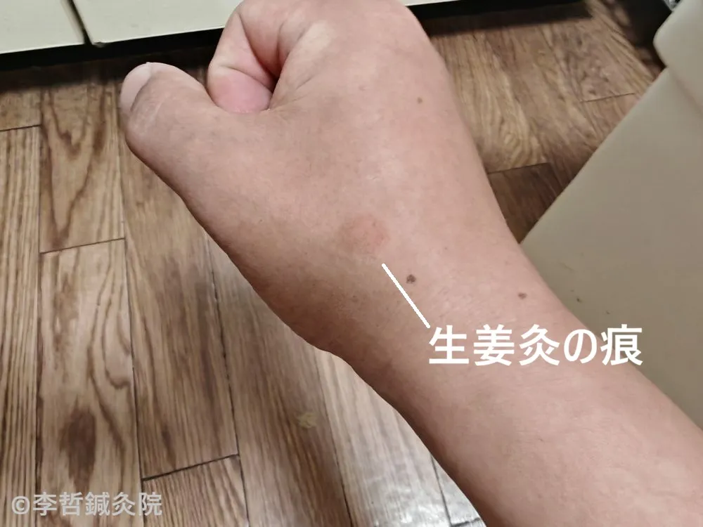 右手の親指付近に残った生姜灸の赤い痕