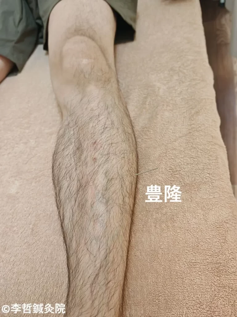 足の豊隆に刺した鍼の施術写真（ツボ名入り）