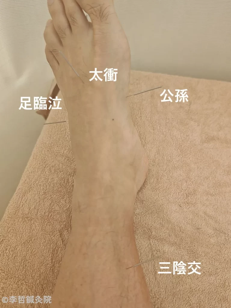 左足の足臨泣・太衝・公孫・三陰交に鍼をした施術画像。上から撮影し、各ツボ名を白文字で表記している。