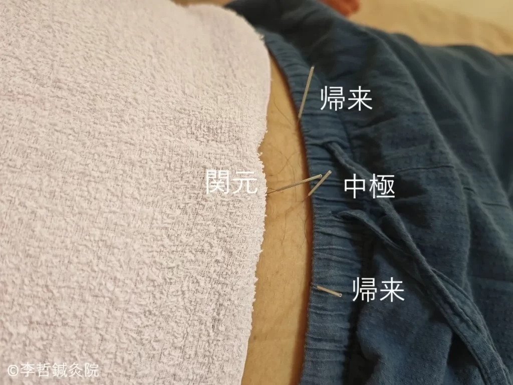 尿の泡立ち改善のために下腹部のツボ(中極・関元・帰来)へ行った鍼施術