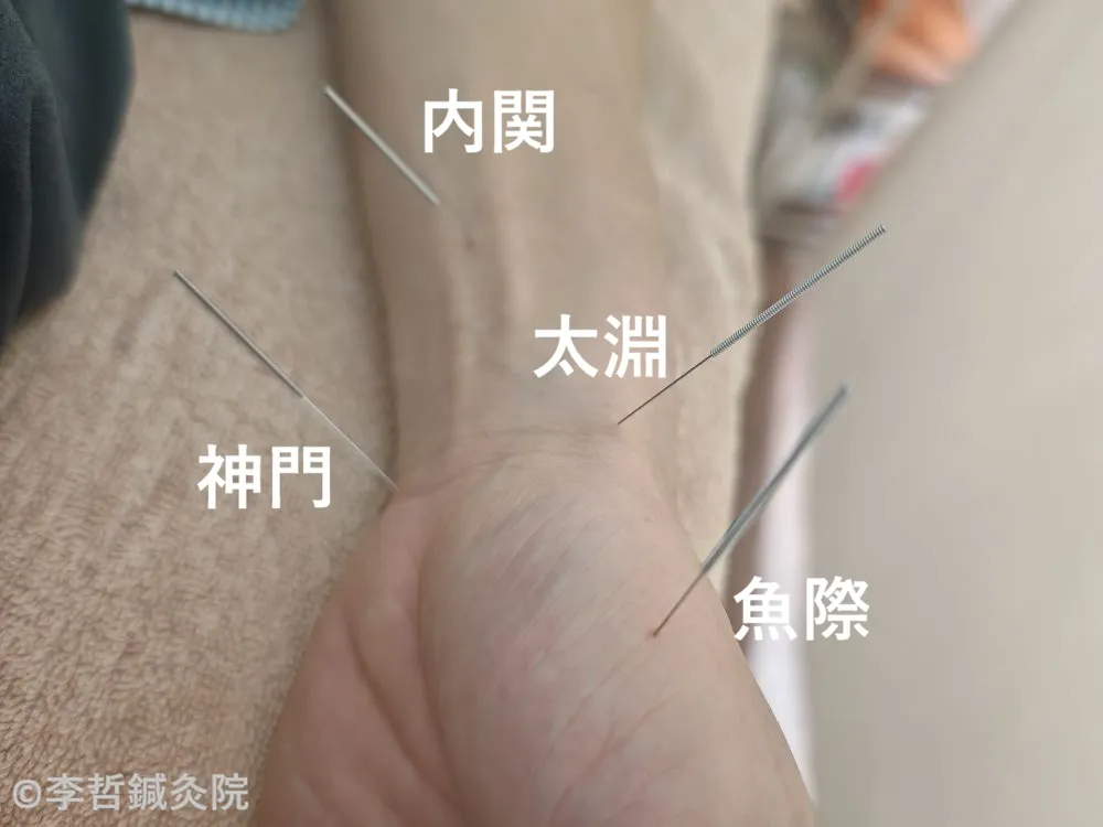 左手の神門・太淵・内関・魚際に鍼をした施術画像。手首から頭方向へ向けて撮影し、各ツボ名を白文字で表記している。