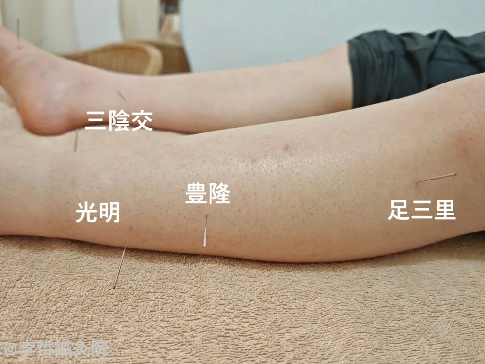 光明・豊隆・足三里・三陰交に刺した鍼の様子