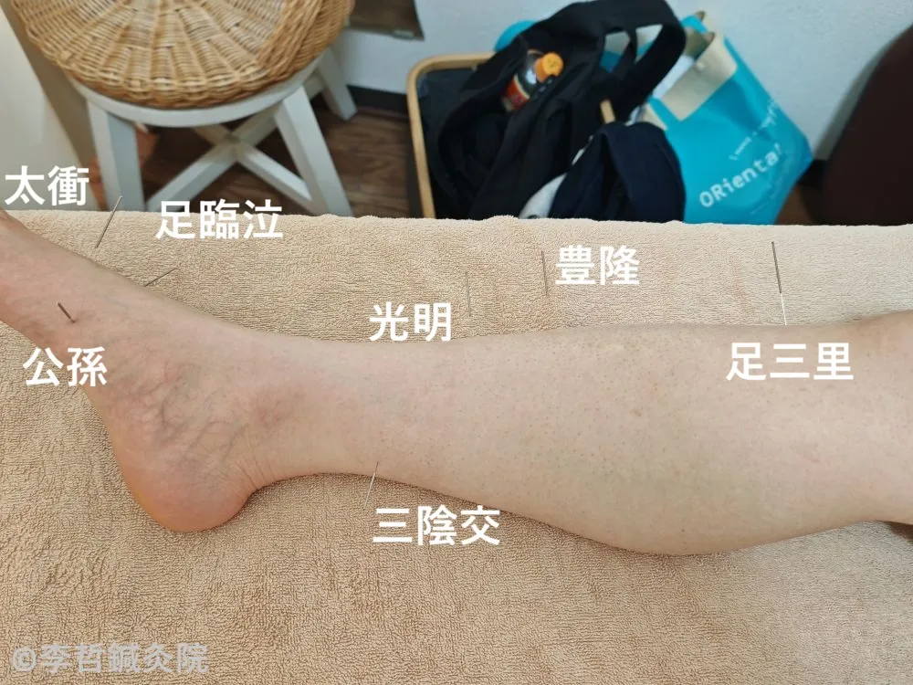 右足の三陰交・公孫・光明・豊隆・足三里・太衝・足臨泣に刺した鍼