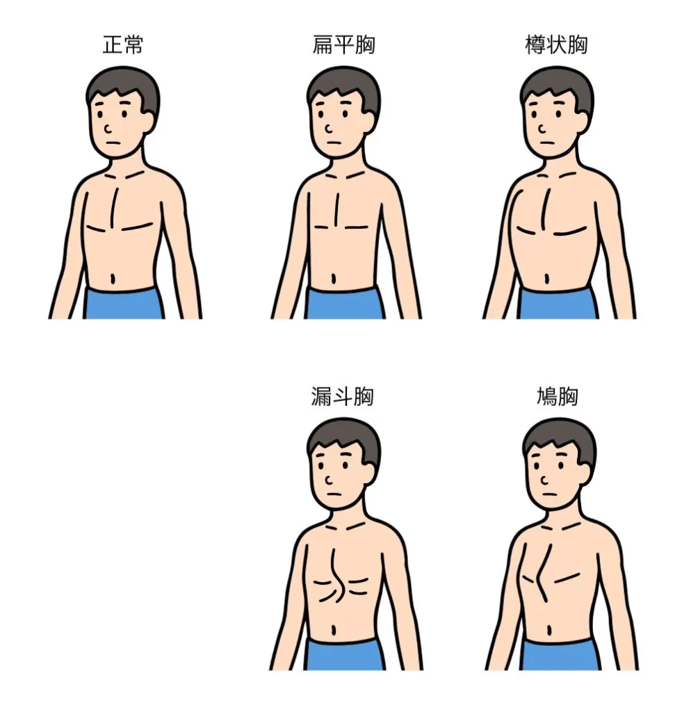 正常胸と漏斗胸を含む胸郭変形の比較イラスト