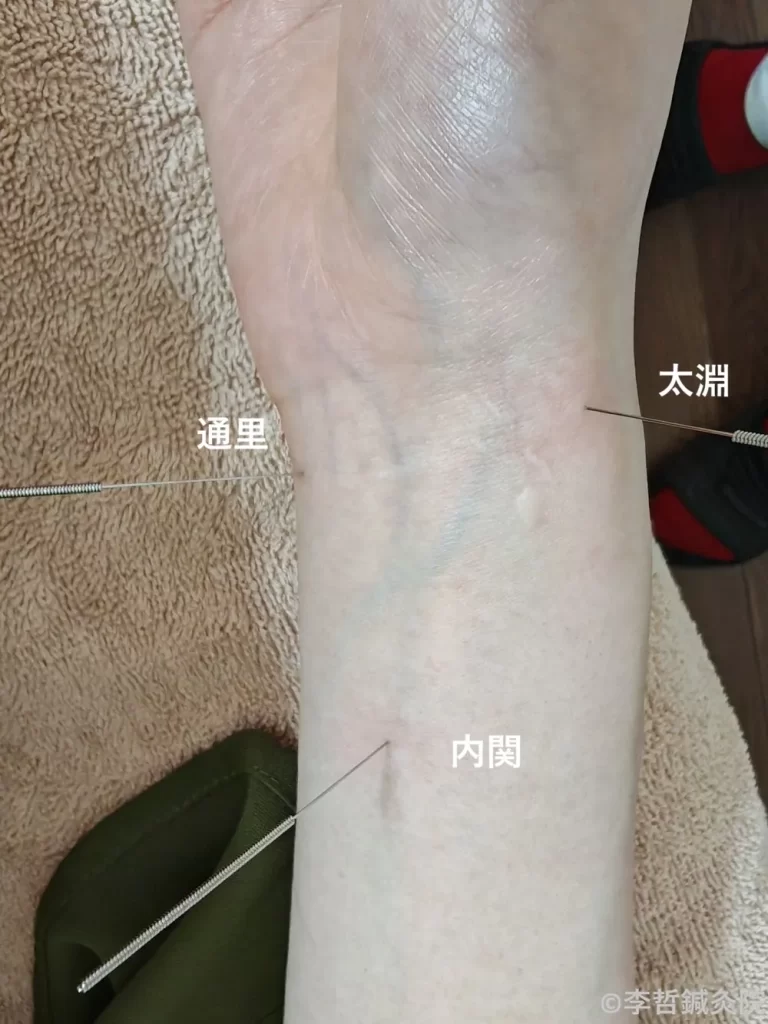 太淵・通里・内関に刺した鍼の様子