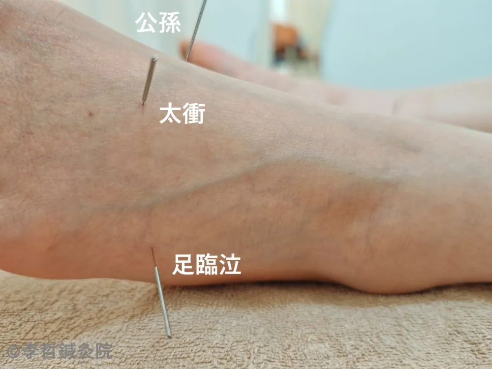 足の太衝・足臨泣・公孫に刺した鍼の様子