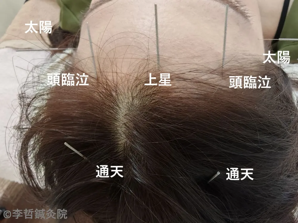 頭臨泣・上星・通天・太陽に刺した鍼の様子